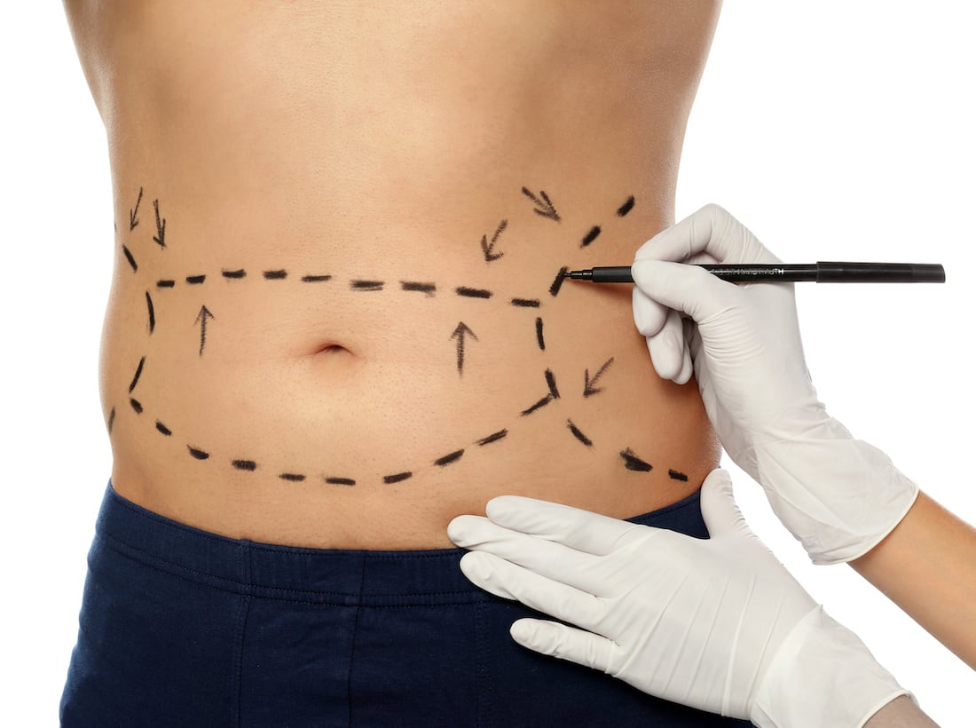 Abdominal etching Bordeaux