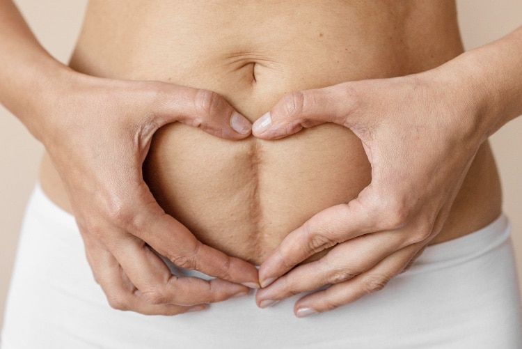 Photo du ventre d'une femme post accouchement