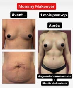 Photo avant après intervention pour Mommy Makeover